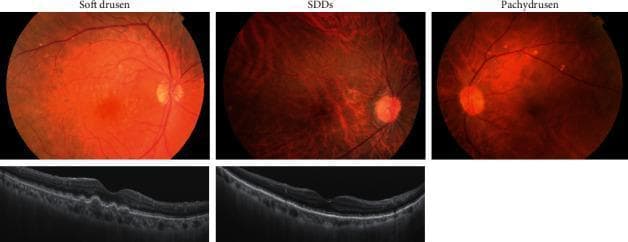 This medical comparison image displays fundus color photographs and corresponding swept-source optical coherence tomography (OCT) scans for three phenotypes of age-related macular degeneration (AMD): soft drusen, subretinal drusenoid deposits (SDDs), and pachydrusen.