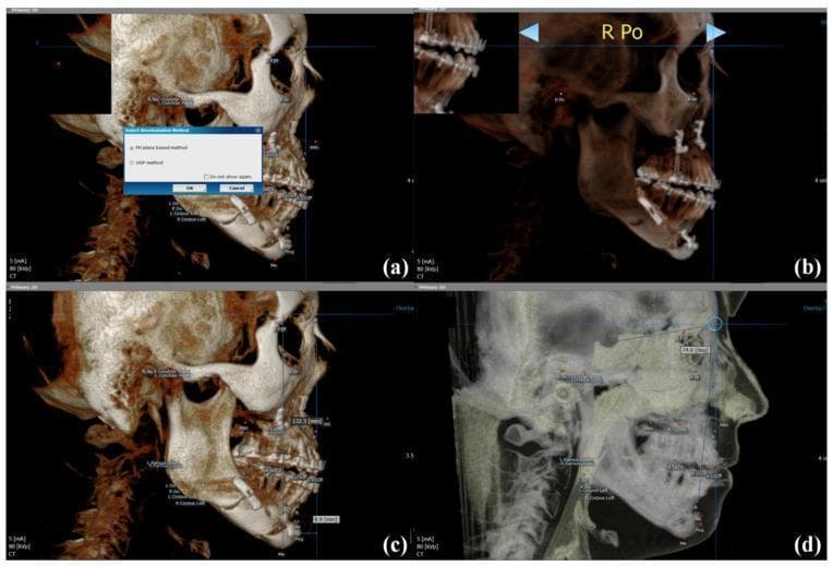 This composite diagnostic image demonstrates 3D cephalometric analysis using OnDemand 3D software for orthognathic surgery planning and skeletal stability assessment. Panel (a) shows the initial selection of the orientation method. Panel (b) illustrates 3D head orientation based on the Frankfort Horizontal (FH) plane, utilizing the right porion and bilateral orbitale as landmarks. Panel (c) displays linear measurements on a 3D skeletal volume rendered view, specifically measuring the distance from a Horizontal Reference Plane (HRP) to the menton (Me) and a Vertical Reference Plane (VRP) to the pogonion (Pog) to quantify mandibular position. Panel (d) shows an adjusted opacity view for angular measurement of the SNB angle (Sella-Nasion-B point), used to evaluate the anteroposterior relationship of the mandible to the cranial base. The images feature surgical hardware, including miniplates and screws, from a bilateral sagittal split ramus osteotomy (BSSRO). This toolset is essential for quantifying post-surgical skeletal changes and long-term stability in maxillofacial surgery.