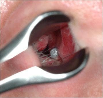 Clinical photograph of an anterior rhinoscopy demonstrating a foreign body in the right nasal cavity. A metallic, cylindrical, threaded titanium structure, representing the apical portion of a dental implant, is seen protruding through the nasal floor. The object is situated medially, adjacent to the nasal septum. The surrounding nasal mucosa appears erythematous and edematous, consistent with localized inflammatory response to the implant's perforation of the cortical bone of the maxilla. Thin, white fibrous or mucous strands are visible spanning the space between the implant and the lateral nasal wall. The image is captured through the blades of a nasal speculum, focusing on the interface between the oral surgical hardware and the respiratory epithelium. This finding illustrates a complication of dental implant placement where excessive vertical length leads to violation of the nasal cavity floor.
