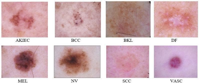 This clinical comparison chart presents eight high-resolution dermoscopic images representing common benign and malignant skin lesions from the ISIC 2019 dataset. The visual compilation serves as a diagnostic reference for dermatology. (1) AKIEC (Actinic Keratosis/Intraepithelial Carcinoma): shows brownish-red, scaly patches with irregular borders. (2) BCC (Basal Cell Carcinoma): displays dark, translucent spots with telangiectasia. (3) BKL (Benign Keratosis-like Lesion): exhibits a uniform light brown pigment and smooth texture. (4) DF (Dermatofibroma): characterized by a central white scar-like area with a peripheral reddish-brown halo. (5) MEL (Melanoma): demonstrates classic asymmetry, irregular borders, and variegated dark brown to black pigmentation. (6) NV (Melanocytic Nevus): shows a symmetric, well-defined brown lesion with uniform pattern. (7) SCC (Squamous Cell Carcinoma): presents as an erythematous, scaly plaque with poorly defined margins. (8) VASC (Vascular Lesion): appears as a well-circumscribed, cherry-red or purple papule. This comparison aids in the differential diagnosis of pigmented and non-pigmented skin tumors based on morphology, color, and border characteristics.