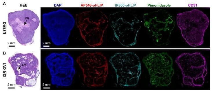 Multi-panel fluorescence microscopy and histological comparison of whole-tumor sections from human cancer xenografts. Row A displays a U87MG (glioblastoma) tumor section, while Row B shows an IGR-OV1 (ovarian cancer) tumor section. The panels compare H&E staining (far left) with multiplexed fluorescence markers including DAPI (blue, nuclei), AF546-pHLIP (red, pH-low insertion peptide), IR800-pHLIP (aqua, pH-low insertion peptide), pimonidazole (green, hypoxia marker), and CD31 (magenta, microvascular marker). In the U87MG tumor, H&E identifies a region of coagulative necrosis (CN) that corresponds spatially with high pHLIP accumulation and pimonidazole-positive hypoxia. In the IGR-OV1 tumor, a region of liquefactive necrosis (LN) shows similar pHLIP and hypoxia localization. Both tumor models demonstrate that pHLIP-based probes preferentially accumulate in hypoxic and necrotic regions, which are characterized by diminished CD31-stained microvascular density. The identical distribution of red (AF546) and aqua (IR800) signals validates the reliability of pHLIP variants for targeting the acidic tumor microenvironment.