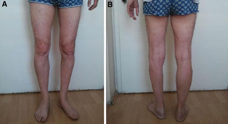 This clinical photograph consists of two panels, (A) anterior and (B) posterior views, demonstrating significant unilateral lower limb pathology in a standing patient. The primary finding is marked amyotrophy (muscle wasting) of the left lower leg. The anterior view (A) reveals a noticeable reduction in the girth of the left calf compared to the right, with the left foot exhibiting a degree of external rotation. The posterior view (B) emphasizes the loss of muscle bulk in the gastrocnemius and soleus complexes on the left side, resulting in a thinner contour of the lower leg and more prominent bony landmarks at the ankle joint. The right lower limb appears to have normal muscle mass and alignment. This comparison chart of anatomical views illustrates clinical signs characteristic of focal motor neuron diseases, peripheral nerve injuries, or unilateral radiculopathies. The content is suitable for medical education focusing on physical examination, neurology, and musculoskeletal assessment to teach the visual identification of muscle atrophy and associated postural changes.