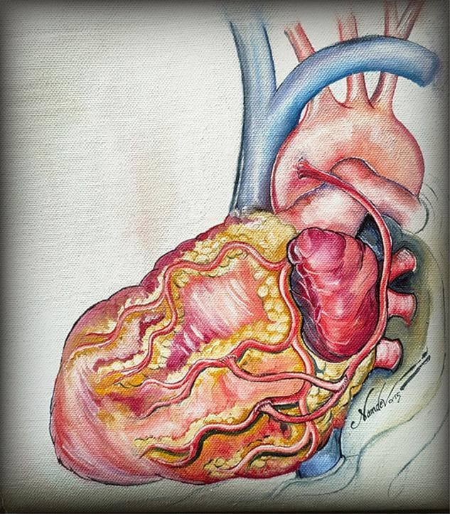 This medical illustration depicts the external anatomy of a human heart with a focus on surgical revascularization. The artwork shows the heart in an anterior view, highlighting the epicardial surface with prominent fatty tissue (yellow) and myocardium (red/pink). Key vascular structures include the superior vena cava (blue), the aortic arch with its branching vessels, and the pulmonary trunk. The illustration specifically demonstrates a 'baby Y' arterial anastomosis technique, where supplementary arterial conduits are grafted onto a parent bypass limb. Red-colored arteries, representing coronary bypass grafts, are shown in a branching pattern, with a proximal anastomosis connecting a secondary limb to the main conduit to supply multiple target vessels, such as the obtuse marginal or diagonal arteries. This anatomical diagram serves to educate on total arterial revascularization strategies in coronary artery bypass grafting (CABG) surgery, emphasizing the distribution and pattern of surgical anastomoses to restore myocardial blood flow.