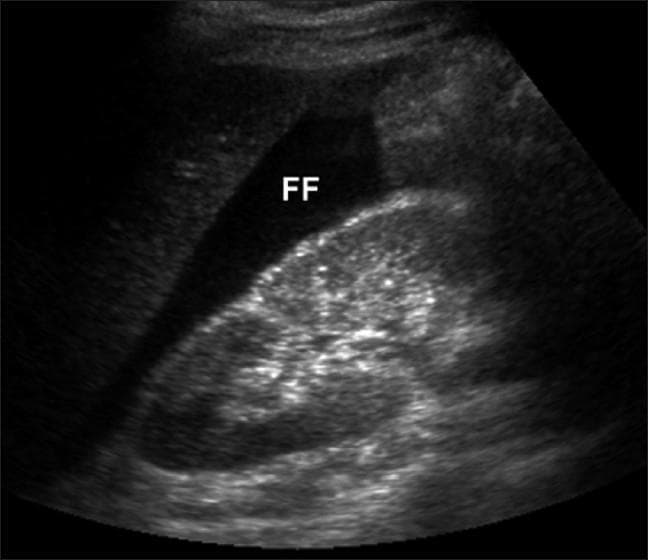 A diagnostic ultrasound image of the right upper quadrant (Morison's pouch) demonstrating a significant amount of free intraperitoneal fluid. The fluid is identified by a prominent anechoic (black) triangular region labeled 'FF', located in the potential space between the liver and the kidney. The kidney displays a typical reniform shape with a heterogeneous parenchymal echotexture and a hyper-echogenic renal sinus. The liver is visible as a more homogeneous, moderately echogenic structure adjacent to the fluid collection. This finding is clinically significant for hemoperitoneum, consistent with internal hemorrhage often seen in acute conditions such as a ruptured ectopic pregnancy. The image illustrates a key component of the Focused Assessment with Sonography for Trauma (FAST) exam, used to identify free fluid in the peritoneal cavity.