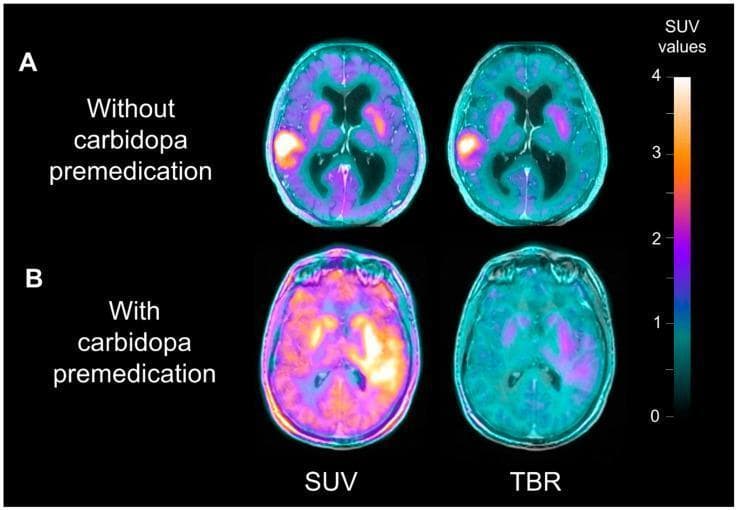 This diagnostic image displays axial 18F-FDOPA PET/MRI scans of the brain, comparing two patients with IDH-wildtype glioblastoma to demonstrate the effect of carbidopa premedication on image contrast. The visualization uses two imaging metrics: Standardized Uptake Value (SUV) and Tumor-to-Healthy-Brain Ratio (TBR). Row A (no carbidopa) shows a localized high-intensity SUV signal in the left hemisphere glioblastoma with low background uptake in healthy brain tissue. Row B (with carbidopa) illustrates significantly increased background SUV throughout the striatum and cortex, which reduces the visual contrast between the tumor and healthy tissue on the SUV parametric map. The corresponding TBR parametric images (right column) demonstrate how normalizing the signal to healthy brain tissue improves tumor definition and contrast, particularly in the premedicated patient (B) where the tumor otherwise blends with the elevated background. A color scale indicates SUV values from 0 to 4. This comparison is clinically relevant for neuro-oncology imaging protocols, highlighting how carbidopa increases tracer availability and the necessity of TBR maps for accurate tumor delineation.