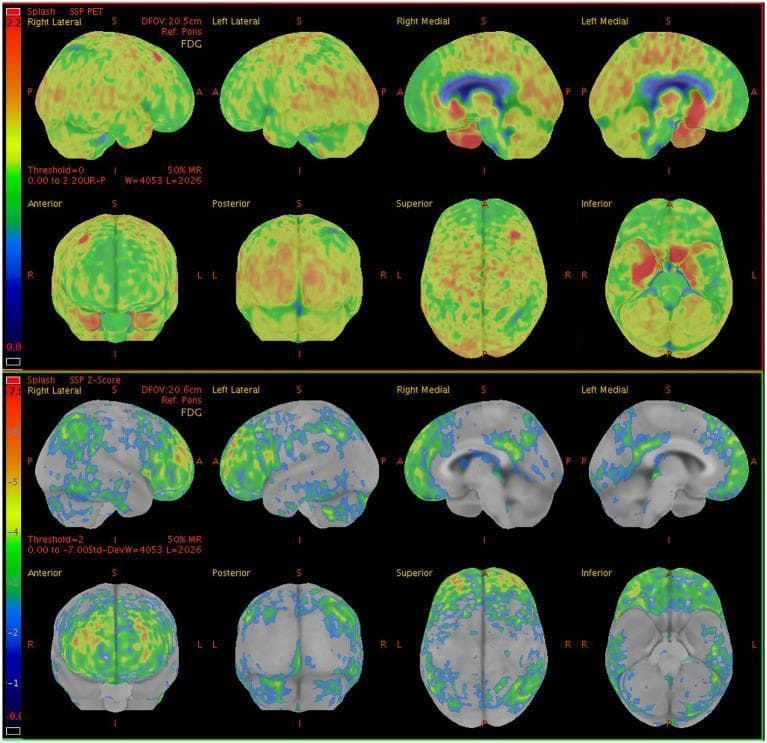 This diagnostic image displays 18F-FDG PET (fluorodeoxyglucose positron emission tomography) brain scans from a 60-year-old male presenting with seizures and memory impairment. The figure includes two rows of multi-planar reconstructions: the top row shows absolute metabolic uptake maps (SSP PET), and the bottom row displays corresponding semi-quantitative Z-score maps (SSP Z-Score) comparing the patient to a normative database. Visualized planes include lateral and medial surface views, as well as anterior, posterior, superior, and inferior projections. The Z-score maps utilize a colorimetric scale where cool colors (blue/green) represent hypometabolism and warm colors (red/orange) represent hypermetabolism. Significant bilateral hypometabolism is noted in the lateral and medial prefrontal lobes, posterior cingulate gyrus, precuneus, inferior parietal lobes, and lateral occipital regions, including the primary visual cortex. In contrast, prominent focal hypermetabolism is demonstrated in the bilateral medial temporal lobes. This metabolic pattern—diffuse cortical hypometabolism with localized medial temporal hypermetabolism—is clinically relevant in the evaluation of autoimmune encephalitides, such as LGI1-antibody encephalitis, where PET can detect functional abnormalities even when structural MRI is unremarkable.