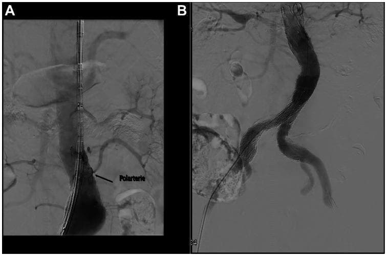This composite of two diagnostic angiograms (A and B) illustrates a standard Endovascular Aneurysm Repair (EVAR) procedure for an infrarenal abdominal aortic aneurysm. Image A displays the pre-deployment or intra-procedural phase, showing a catheter and stent-graft delivery system positioned within the abdominal aorta. A black arrow labeled 'Polarterie' indicates the presence of a left accessory renal artery (ARA) that is anatomically situated within the landing zone of the graft, highlighting the challenge of unintentional vessel coverage during repair. Image B shows the successful post-deployment of a bifurcated stent-graft. The device exhibits a characteristic metallic stent skeleton with a woven graft material, forming a main body in the aorta that bifurcates into two iliac limbs to maintain distal perfusion. The image demonstrates proper graft apposition and exclusion of the aneurysmal sac, with no visible endoleaks. This content is relevant for vascular surgery and radiology education regarding aortic anatomy, graft selection, and the management of accessory renal vessels during EVAR.