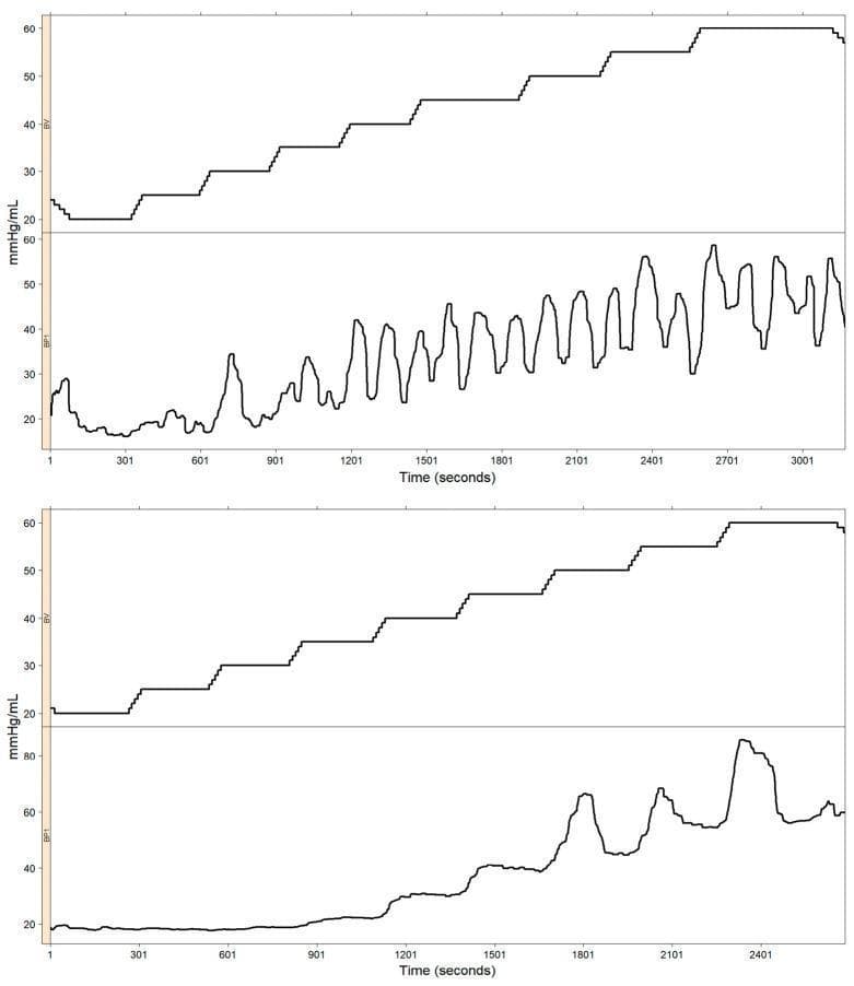 This comparison chart displays time-series data from two different EndoFLIP (Endoluminal Functional Lumen Imaging Probe) measurements, evaluating the volume-pressure relationship in the esophagus. Each panel (upper and lower) consists of two synchronous plots: a top plot showing balloon volume (BV in mL) and a bottom plot showing intra-balloon pressure (BP1 in mmHg) over approximately 3000 seconds. Both panels demonstrate a controlled, stepwise increase in balloon volume from 20 mL to 60 mL. The upper panel illustrates a successful monotonic relationship where pressure increases and oscillates concurrently with volume increments, indicating reliable distensibility data. In contrast, the lower panel depicts a 'failed' monotonic relationship; intra-balloon pressure remains abnormally low and non-responsive during initial volume steps, only showing a significant rise after 1201 seconds. This discrepancy may indicate technical artifacts such as balloon twisting or squeezing, which interfere with the sensor's ability to record uniform pressure. These charts are essential for identifying quality control issues in impedance planimetry studies used to assess esophageal motility and distensibility.
