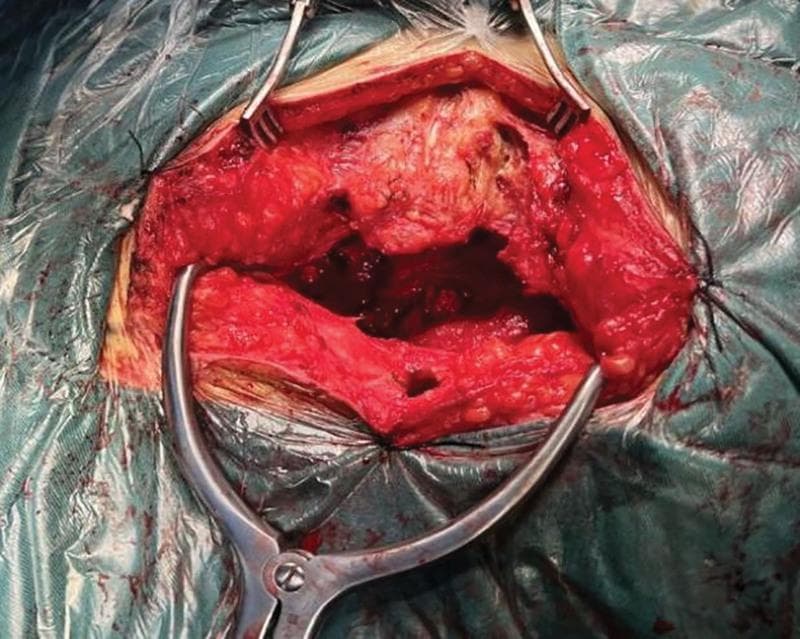 This clinical photograph captures an intraoperative view of a sacrococcygeal surgical procedure. The patient is in a prone position, and an inverted 'Y'-shaped longitudinal incision has been made extending from the S1 level toward the posterior midline of the coccyx. The surgical field is maintained using several metal retractors, including a Weitlaner-style retractor at the inferior margin, which pull back the skin and subcutaneous fat to expose deeper muscular and fascial layers. The exposed area reveals raw, erythematous tissue and a deep cavity in the sacrococcygeal region, corresponding to the space created during the resection of a sacrococcygeal teratoma (SCT). The surgical approach targets the S3 to S5 laminae, providing access to the anterior sacrum and the retroperitoneal space behind the rectum. Visible landmarks include the incised subcutaneous tissue and the underlying musculature of the gluteal and sacral regions. This image demonstrates the parasacrococcygeal approach for the management of complex pelvic masses.