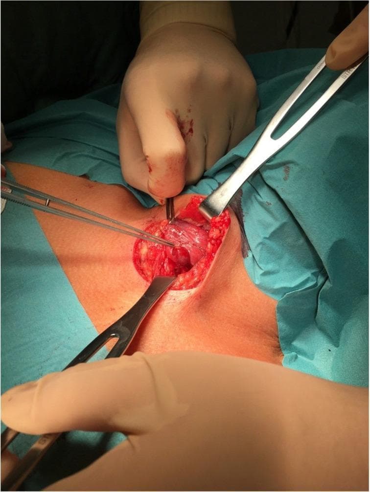 This clinical photograph shows an intraoperative view of a surgical procedure in the anterior neck region, likely a thyroidectomy or parathyroidectomy. The surgical field is exposed via a transverse cervical incision, with the underlying thyroid gland visible as a reddish, vascularized lobular structure. Multiple surgical instruments are in use for tissue manipulation and exposure: a pair of surgical forceps is retracting thyroid tissue to the left, while two metal retractors (superior and inferior) maintain the patency of the incision. A pointed probe or dissector is positioned in the center, directed toward a localized area on the thyroid surface to facilitate the identification of a parathyroid gland (PTG). The field demonstrates standard surgical anatomy and instrumentation for endocrine surgery of the neck, highlighting the careful dissection required to distinguish the PTG from surrounding thyroid parenchyma.