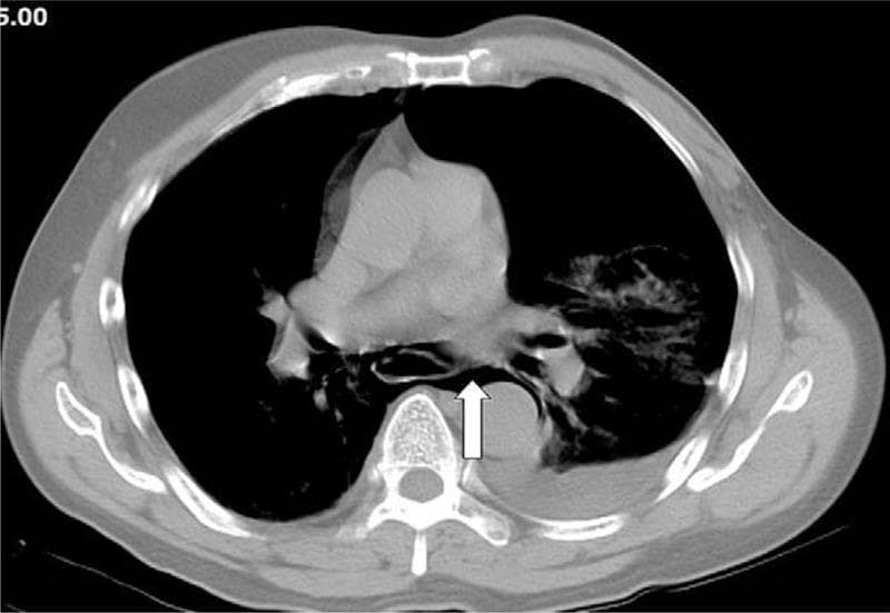 Axial contrast-enhanced thoracic CT scan at the level of the pulmonary arteries. The image demonstrates a prominent pneumomediastinum, characterized by extraluminal air (low-attenuation/black pockets) dissecting through the mediastinal planes and encompassing the peri-esophageal space (indicated by a white arrow). This finding is highly suggestive of Boerhaave syndrome (spontaneous esophageal perforation) given the clinical context of post-emetic chest pain. Additionally, there is a significant left-sided pleural effusion/hemothorax appearing as a hyperdense fluid collection in the dependent portion of the left hemithorax, with associated compressive atelectasis of the adjacent left lower lobe parenchyma. The right hemithorax appears clear. This diagnostic image is intended for medical education regarding the imaging hallmarks of esophageal rupture and secondary mediastinal air and pleural complications.