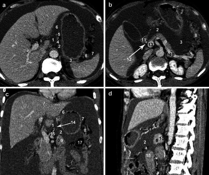 This set of diagnostic images consists of multiplanar computerized tomography (CT) scans—axial (a, b), coronal (c), and sagittal (d) views—demonstrating the complex anatomy of the omental bursa (lesser sac) and its recesses. The images utilize numerical labeling to identify 18 key anatomical structures. The superior recess (1) is visualized in the axial plane surrounding the caudate lobe of the liver, bounded anteriorly by the hepatogastric ligament (5). The inferior recess (2) and splenic recess (3) are shown in relation to the pancreas (9), stomach, and transverse colon (17). The coronal view highlights the foramen bursae omenti majoris (14), representing the communication between the superior and inferior compartments. Vasculature, including the splenic artery (10), common hepatic artery (12), portal vein (13), and left gastric artery (15), is clearly demarcated to show their proximity to the bursal spaces. These images are pedagogically significant for understanding the three-dimensional boundaries of the omental bursa, which is critical for identifying pathological fluid collections in conditions such as pancreatitis or metastatic ovarian carcinoma.