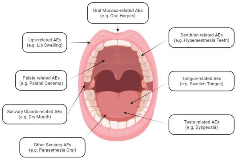 This medical anatomical diagram provides an anatomo-physiological scheme of Oral Adverse Events Following Immunization (AEFI). The central illustration is a simplified, frontal view of an open human oral cavity, featuring labels that categorize adverse events (AEs) by specific anatomical regions and functions. Key regions identified include the oral mucosa (linked to oral herpes), the lips (lip swelling), the palate (palatal oedema), the salivary glands (dry mouth), and the dentition (hyperaesthesia teeth). Additionally, the diagram highlights functional adverse events related to the tongue (swollen tongue), taste (dysgeusia), and other sensory modalities (oral paraesthesia). This educational visual serves as a de novo classification tool to help clinicians and researchers identify and categorize various vaccine-related oral symptoms that are otherwise dispersed across different levels of the MedDRA hierarchy. It is designed for medical professionals and students to facilitate systematic clinical assessment of oral health changes post-vaccination.