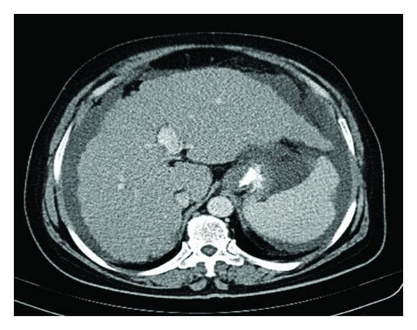 This diagnostic image is an axial slice from a contrast-enhanced computerized tomography (CT) scan of the upper abdomen. The imaging reveals significant signs of chronic liver disease and portal hypertension. The liver exhibits a nodular surface contour and a heterogeneous parenchymal texture characteristic of cirrhosis. Marked splenomegaly is present, with the spleen appearing significantly enlarged. A prominent feature is the large volume of ascites, visualized as a low-attenuation fluid collection surrounding the liver (perihepatic space) and the spleen (perisplenic space). The vertebral body is visible posteriorly, and central vascular structures, including the portal vein and aorta, can be identified. This scan is educationally significant for demonstrating the classic triad of radiological findings in advanced liver cirrhosis: a nodular liver, splenomegaly, and free intraperitoneal fluid (ascites).