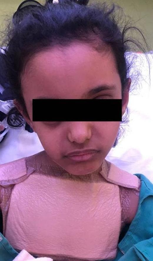 A clinical photograph of a pediatric patient presenting with torticollis (wry neck) and a strained facial expression indicative of clinical discomfort. The image shows a significant lateral tilt and rotation of the head, a common sign of cervical spine instability or muscular spasm. A rigid cervical collar (C-collar) with an anterior thoracic component is applied to the neck and upper chest to provide external stabilization and immobilization of the cervical spine. The clinical context suggests this presentation is associated with Grisel syndrome, a non-traumatic rotatory atlantoaxial subluxation that can occur following inflammatory processes in the head and neck, such as a retropharyngeal abscess. This visual material serves as a teaching tool for recognizing postoperative complications in otolaryngology and the physical manifestations of atlantoaxial instability.