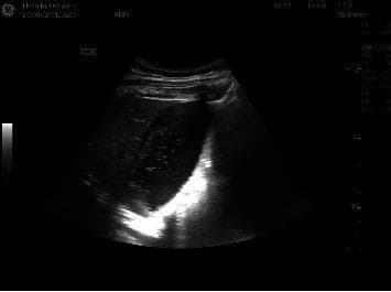 This abdominal diagnostic ultrasound image focuses on the right upper quadrant, specifically visualizing the gallbladder and liver parenchyma. The gallbladder is prominently distended with anechoic contents. Notably, the ultrasound lacks classic diagnostic signs of acute cholecystitis, such as gallbladder wall thickening (greater than 3mm), pericholecystic fluid, or the presence of intraluminal gallstones. In the perihepatic space, there is a small, localized collection of hypoechoic fluid, described as a minimal perihepatic fluid pocket. The adjacent hepatic tissue appears relatively homogenous. This image is clinically relevant for teaching the differential diagnosis of abdominal pain in obstetric or general surgical patients, where distention may occur in the absence of primary inflammatory cholecystitis. It highlights the importance of distinguishing between simple gallbladder distension and acute cholecystitis during sonographic evaluation.