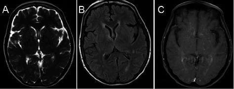 This diagnostic imaging panel presents three axial brain MRI sequences (T2-weighted, FLAIR, and post-contrast T1-weighted) illustrating periventricular and parenchymal abnormalities. Panel A (T2-weighted) shows areas of hyperintense signal prolongation in the periventricular white matter, particularly near the anterior and posterior horns of the lateral ventricles. Panel B (FLAIR) highlights these same hyperintensities by suppressing the cerebrospinal fluid (CSF) signal, revealing multifocal white matter involvement. Panel C (post-contrast T1-weighted) demonstrates mild, diffuse enhancement within the periventricular regions and subtle multifocal punctate enhancement throughout the brain parenchyma, indicative of blood-brain barrier disruption. These findings are clinically relevant for the diagnosis of inflammatory or vasculitic processes, such as lymphocytic vasculitis, presenting with progressive neurological symptoms like headaches and gait instability. The imaging is targeted at medical students and radiology residents as a representation of diffuse inflammatory central nervous system disease.
