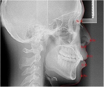 This diagnostic image is a lateral cephalometric radiograph, a standardized orthodontic x-ray used for skeletal and soft tissue profile analysis. The radiograph displays a lateral view of the human skull, including the cranium, cervical vertebrae, and facial bones, with a specific focus on the dentofacial structures in centric occlusion. Red annotations mark key soft tissue cephalometric landmarks along the facial profile: Ns (Soft tissue nasion) at the root of the nose; Pn (Pronasale) at the nasal tip; Sn (Subnasale) at the junction of the nose and upper lip; Ls (Labial superius) on the upper lip; Li (Labial inferius) on the lower lip; and Pos (Soft tissue pogonion) on the chin. The image demonstrates the relationship between the underlying hard tissue (maxilla, mandible, and teeth) and the overlying soft tissue drape. This visual is clinically significant for orthodontic diagnosis, treatment planning, and evaluating facial aesthetics and skeletal malocclusions.