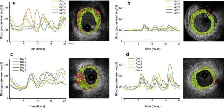 This composite figure presents a four-panel comparison (a-d) of continuous glucose monitoring (CGM) data and corresponding coronary intravascular ultrasound (IVUS) imaging. On the left side of each panel, line graphs illustrate blood glucose level fluctuations (mg/dl) over 24-hour cycles for five consecutive days. These graphs demonstrate varying degrees of glycemic variability, quantified by the mean amplitude of glycemic excursion (MAGE). On the right side of each panel, iMap-coronary IVUS cross-sectional images characterize plaque morphology and composition in the coronary artery. The iMap analysis utilizes color-coding to visualize tissue components: green represents fibrotic tissue, yellow indicates lipidic tissue, pink/red denotes necrotic tissue, and white signifies calcified tissue. The visual data highlights the clinical association between high glycemic excursion (seen in panels a and c) and increased necrotic or lipidic plaque components compared to patients with more stable glucose levels (panel b) or different inflammatory profiles (panel d). This educational material demonstrates the relationship between metabolic control and atherosclerosis progression.