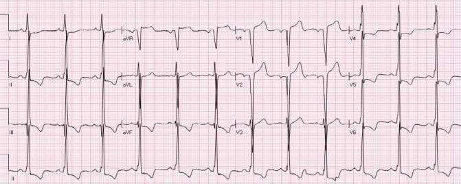 This diagnostic image is a 12-lead electrocardiogram (ECG) demonstrating secondary repolarization abnormalities associated with Left Ventricular Hypertrophy (LVH). Key diagnostic findings include voltage criteria for LVH, characterized by high-amplitude QRS complexes in the precordial leads. Distinct ST-segment and T-wave changes are present: non-ischemic ST elevation (STE) is visible in lead aVR and the right precordial leads V1-V3. Conversely, prominent ST-segment depression with concomitant T-wave inversion (strain pattern) is observed in the lateral and inferior leads, specifically leads I, II, III, aVF, and V4-V6. These findings illustrate the 'strain pattern' of LVH, which is a critical differential diagnosis for ST-segment elevation myocardial infarction (STEMI). The tracing serves as an educational example of how chronic structural heart changes can mimic or mask acute coronary syndromes, emphasizing the importance of recognizing voltage criteria and the distribution of repolarization deviations in clinical cardiology.