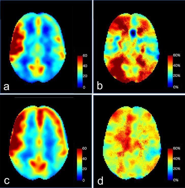 This diagnostic visual contains four axial brain slices (a-d) using Arterial Spin Labeling (ASL) perfusion MRI to assess cerebral blood flow (CBF) and cerebrovascular reactivity (CVR). The images utilize a color-coded pseudocolor scale where red/yellow indicates high perfusion and blue indicates low perfusion. Panels (a) and (c) represent baseline pre-acetazolamide states, both showing focal hyperperfusion in the right frontotemporal region. Panels (b) and (d) demonstrate the response to an acetazolamide challenge. Image (b) shows impaired CVR in the previously hyperperfused right frontotemporal zone (appearing blue/green) relative to the robust augmentation in the surrounding right hemisphere and normal response in the left hemisphere. Follow-up image (d) demonstrates a normalized bilateral augmentation response, indicating a recovery of cerebrovascular reserve. This series is used in neuroradiology to evaluate hemodynamics in cases of vasculitis or severe carotid stenosis, illustrating the concept of 'luxury perfusion' and subsequent recovery of normal vascular reactivity following clinical management.