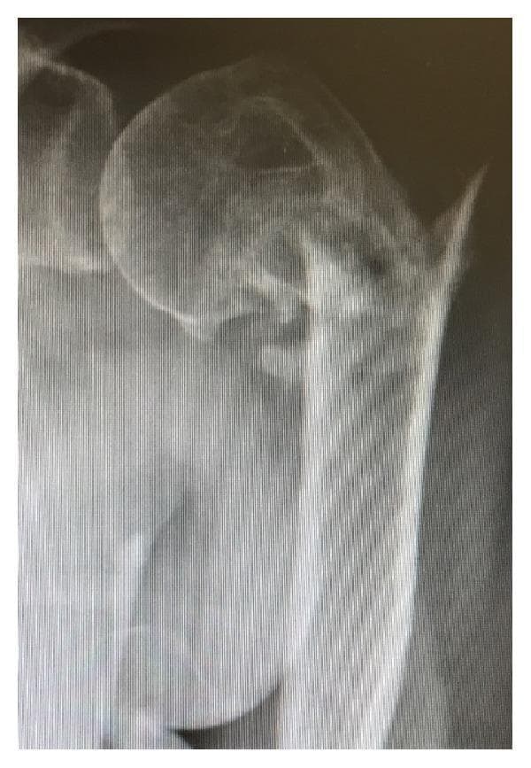 This diagnostic image is an anteroposterior (AP) radiograph of the left shoulder, illustrating a chronic, two-part proximal humerus fracture with malunion. The primary pathology involves a fracture at the surgical neck, resulting in significant varus malalignment of the humeral head relative to the shaft. A distinctive visual feature is the sharp, laterally projecting bony spike originating from the proximal aspect of the humeral shaft fragment. The cortical surface at the fracture site shows clear disruption and displacement, while the humeral head is angulated medially (varus). This imaging demonstrates the anatomical consequences of nonoperative management in certain proximal humerus fractures, emphasizing the structural deformity and the potential for limited range of motion or impingement due to the malaligned bone fragments and the prominent lateral spike.