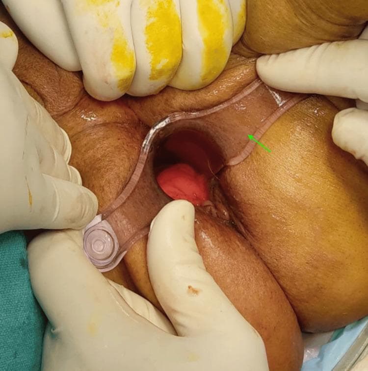 This clinical photograph shows a proctoscopic examination of the perianal and rectal region. A transparent, rigid plastic proctoscope (indicated by a green arrow) is inserted into the anal canal to provide visualization. Centrally located within the lumen of the proctoscope is a prominent, protruding rectal mass. The mass is deep red in color, demonstrating a smooth, glistening, and edematous surface characteristic of rectal prolapse or a large internal hemorrhoid. The surrounding perianal skin appears thickened and congested. The procedure is being performed in a clinical setting, with gloved hands visible retracting the surrounding gluteal tissue to facilitate the insertion of the scope. This image illustrates the diagnostic visualization required before surgical interventions such as the Thiersch procedure for managing rectal protrusion in geriatric patients with high-risk comorbidities.