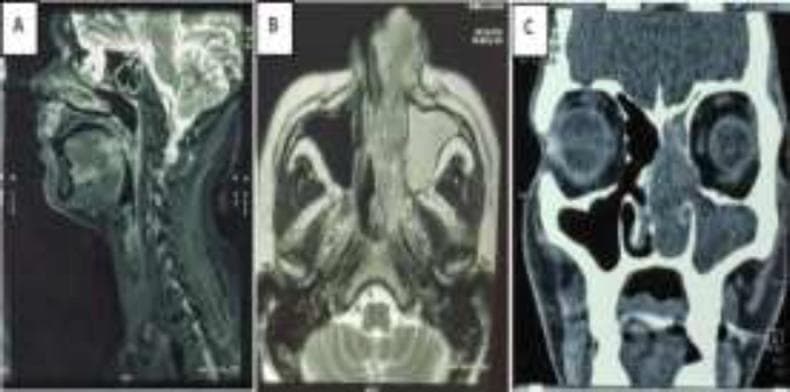This composite of diagnostic images (MRI and CECT) illustrates a large sinonasal mass with aggressive features. Panel A (sagittal MRI) shows an enhancing lesion involving the base of the tongue. Panel B (axial MRI) reveals an irregular, heterogeneously lobulated soft tissue mass in the left nasal cavity. The mass extends into the deeper fascial planes at the medial orbital canthus and posteriorly into the left nasopharynx, accompanied by complete mucosal thickening of the left maxillary sinus. Panel C (coronal CECT) demonstrates the mass filling the left nasal cavity, causing significant mass effect evidenced by the rightward bowing of the nasal septum and widening of the left osteomeatal complex. Notable bony destruction includes erosion of the left lamina papyracea. These findings are clinically representative of a malignant process such as embryonal rhabdomyosarcoma or squamous cell carcinoma. The images are essential for understanding sinonasal anatomy, tumor staging, and the impact of large lesions on surrounding paranasal and orbital structures.