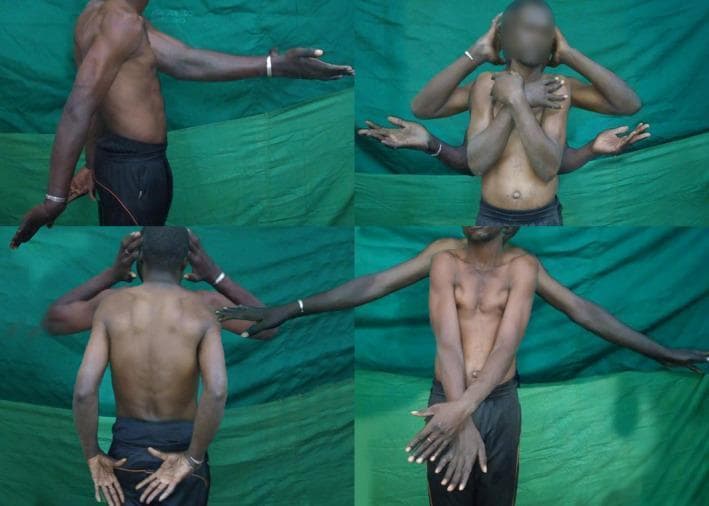 A composite of four clinical photographs demonstrating the range of motion (ROM) in a 26-year-old male with chronic (2-year) bilateral symmetric anterior shoulder dislocations. The images show a slender patient in various poses to assess joint function. Key visual features include: 1) A lateral view showing restricted shoulder extension and lateral abduction. 2) An anterior view with hands behind the head, indicating preserved but limited overhead reaching and external rotation. 3) A posterior view showing the patient attempting internal rotation with hands placed on the lower back (Hand-to-Sacrum test), demonstrating significant limitations in reaching the upper back. 4) A front view with arms crossed over the chest (cross-body adduction) and partial abduction. Visible signs include a flattening of the deltoid contour and subtle 'sulcus signs' indicative of glenohumeral instability. The images illustrate the functional adaptation to long-standing, unreduced dislocations, highlighting the discrepancy between the patient's ability to perform activities of daily living and the objective restriction in terminal ROM, particularly internal rotation and full abduction.