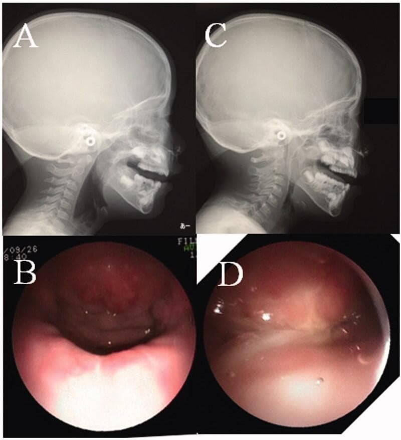 This composite clinical figure demonstrates preoperative and postoperative assessments of velopharyngeal function using lateral pharyngograms (LPG) and nasopharyngoscopy (NPS). Panels A and C show lateral cephalometric radiographs (LPG) during phonation. Preoperatively (A), there is a distinct radiolucent gap between the soft palate and the posterior pharyngeal wall, indicating velopharyngeal insufficiency (VPI). Postoperatively (C), the soft palate is seen in direct contact with the posterior pharynx, indicating successful closure. Panels B and D provide corresponding endoscopic NPS midline views of the velopharyngeal valve. The preoperative view (B) shows a large central defect (gap) during phonation, which correlates with the radiographic findings of incomplete closure. The postoperative view (D) reveals a completely closed valve with the soft palate meeting the posterior and lateral pharyngeal walls, demonstrating restoration of the anatomical seal required for normal speech. This comparison is used in pediatric plastic surgery and otorhinolaryngology to evaluate surgical outcomes for conditions like cleft palate or short palate.