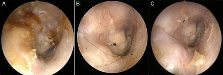 This composite of clinical endoscopic photographs illustrates a comparative study of the right ear canal and epithelial migration. Image A shows the pre-operative ear canal, characterized by the presence of cerumen or pathological debris (dark brown/black mass) obstructing the view of the tympanic membrane. Image B displays the post-operative state, showing a clearer canal with surgical changes and a visible ink marker used for tracking. Image C demonstrates the epithelial migration pattern in a posterior-superior direction, evidenced by the movement of dark ink markings (indicated by a white arrow) along the canal wall. The series serves to educate on otologic surgical outcomes and the physiological process of epithelial self-cleansing in the external auditory canal. Key concepts include postoperative monitoring of ear canal health and the quantification of migration rates (linear movement measured in mm/week) to assess physiological recovery.