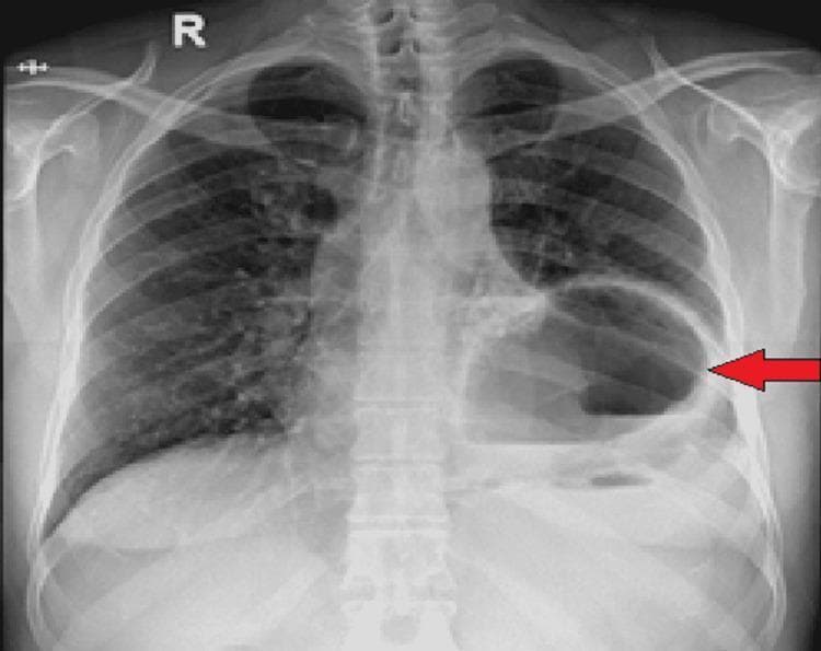 This diagnostic image is an anteroposterior (AP) chest X-ray demonstrating a significant abnormality in the left hemithorax. The primary finding is a large, well-defined cystic structure or gas-filled viscus containing a prominent horizontal air-fluid level, highlighted by a red arrow. This structure occupies a substantial portion of the left lower and mid-thorax, resulting in the compression of the adjacent left lung parenchyma and potential obscuration of the left hemidiaphragm silhouette. A slight rightward mediastinal shift may be present due to the mass effect of the lesion. While the right lung appears relatively clear, the radiographic appearance in the left hemithorax is highly suggestive of a large diaphragmatic hernia (such as a hiatal hernia) with gastric herniation and subsequent gastric outlet obstruction, or potentially a large lung abscess or infected bulla. The clinical context provided confirms this as a diaphragmatic hernia with herniation of the stomach into the thoracic cavity.