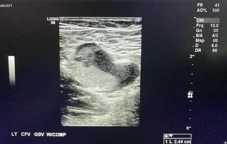 This diagnostic image is a B-mode venous duplex ultrasound of the left lower extremity in a transverse view. The scan focuses on the inguinal region, specifically the junction of the left common femoral vein (CFV) and the great saphenous vein (GSV). The image demonstrates a key diagnostic finding for deep vein thrombosis (DVT): the venous lumen is not anechoic (black) as would be expected with normal blood flow. Instead, it is distended and filled with heterogeneous, intraluminal echoes of mixed echogenicity, indicating an acute thrombus. The labels at the bottom ('LT CFV GSV W/COMP') indicate that the image was captured during a compression maneuver, but the vessel remains patent and non-compressed, confirming the presence of an obstructive clot. Calipers indicate a measurement of 2.44 cm across the vessel bundle. This finding is clinically significant for diagnosing extensive proximal venous thrombosis in the context of symptoms such as leg edema and pain.