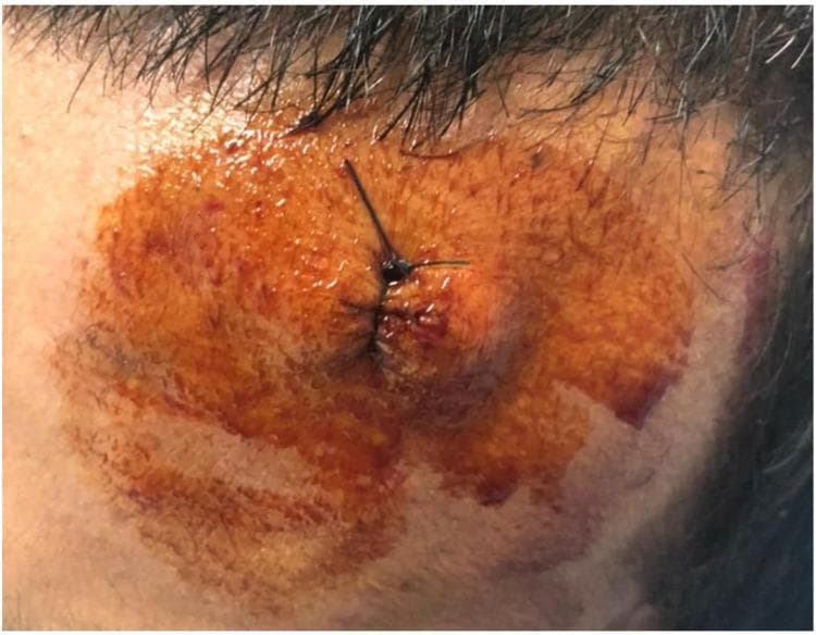 This clinical photograph displays a post-operative sutured wound on the frontal region (forehead) of a human patient near the hairline. The primary focus is a linear laceration that has been primarily closed using multiple simple interrupted, black, non-absorbable sutures. The wound edges appear well-approximated. The surrounding cutaneous tissue exhibits significant trauma-induced changes, most notably a large area of perilesional ecchymosis and bruising, characterized by a spectrum of discoloration ranging from reddish-brown and dark purple to faint yellow-blue. The skin surface is coated with a topical antiseptic solution (likely povidone-iodine), giving it a glossy, orange-tinted appearance. There is evidence of mild localized swelling and dried serosanguinous exudate around the suture entry points. This image serves as a clinical example of soft tissue repair following foreign body removal and illustrates the expected inflammatory and traumatic responses in the immediate post-surgical phase.