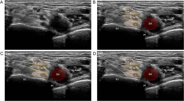 This set of four ultrasound images (A-D) demonstrates the supraclavicular approach for a brachial plexus block using an intertruncal technique. Panels A and B display the short-axis baseline anatomy in the supraclavicular fossa. Key landmarks include the subclavian artery (SA), first rib (R1) with pleural line (Pl), and the anterior scalene muscle (ASM). The brachial plexus is visualized as three distinct neural clusters representing the upper (containing A/P divisions and suprascapular nerve SSn), middle (M), and lower (L) trunks, positioned lateral to the SA. Panel C illustrates a double-injection (DI) technique, where needle trajectories (white dotted arrows) target the intertruncal planes (yellow dashed lines) between the trunks to facilitate local anesthetic spread. Panel D illustrates a triple-injection (TI) technique, where the needle is oriented sequentially toward the epineurium of each individual trunk (lower, middle, then upper). The images serve as an educational guide for regional anesthesia, highlighting needle-target relationships for optimizing nerve block efficacy.