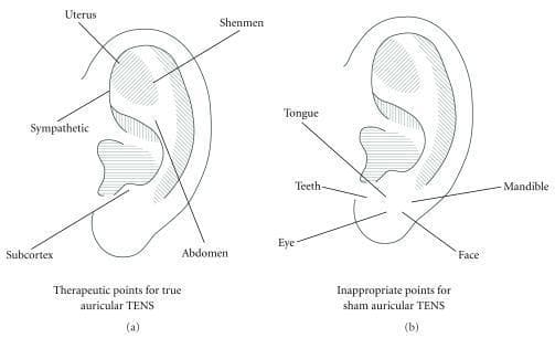 Anatomical diagrams of the human ear illustrating points used for Transcutaneous Electrical Nerve Stimulation (TENS) in an educational or clinical study context. The image is divided into two parts: (a) 'Therapeutic points for true auricular TENS' and (b) 'Inappropriate points for sham auricular TENS.' Diagram (a) highlights five active therapeutic points: Uterus (triangular fossa), Shenmen (superior to the triangular fossa), Sympathetic (internal helix), Abdomen (concha area), and Subcortex (antitragus). Diagram (b) identifies five sham or 'inappropriate' points primarily clustered on the earlobe and lower tragus: Tongue, Teeth, Mandible, Eye, and Face. These diagrams are used to define the placement of electrodes for investigating the analgesic effects of auricular stimulation, distinguishing between specific reflexology-based therapeutic sites and neutral control sites. The illustration utilizes precise anatomical labeling to demonstrate the topographical distribution of acupuncture or TENS points for clinical pain management research.