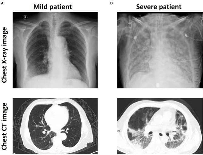 This diagnostic comparison image demonstrates the radiological findings of COVID-19 across two different levels of severity using chest X-ray and CT imaging. Section (A) represents a 'Mild patient,' showing localized patchy shadows and peripheral ground-glass opacities (GGO) primarily in the lower lung fields on X-ray, with corresponding focal GGO visible on the axial CT slice. In contrast, section (B) displays a 'Severe patient' characterized by extensive, bilateral, and confluent pulmonary opacities. The severe X-ray reveals a significant loss of lung lucency and obscuration of the cardiophrenic angles, while the axial CT shows widespread, dense consolidation and diffuse GGO throughout both lung parenchyma. These images highlight the progressive pulmonary damage associated with severe SARS-CoV-2 infection, specifically illustrating how increased opacity density and distribution correlate with clinical severity in viral pneumonia. The material is suitable for medical education in pulmonology and radiology to distinguish disease staging via imaging modalities.