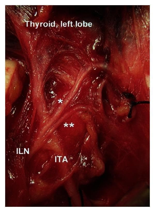 This clinical intraoperative photograph displays the surgical anatomy of the neck, specifically highlighting the neurovascular relationship between the left inferior laryngeal nerve (ILN) and the inferior thyroid artery (ITA). The ILN is seen coursing superiorly and undergoing extralaryngeal terminal division. The bifurcation occurs at the arterial segment, categorized as a Type 1 variation. Two distinct branches are visible: the anterior branch (marked with a single asterisk) and the posterior branch (marked with a double asterisk). The ITA is positioned inferior and lateral to the bifurcation point. Superiorly, the left lobe of the thyroid gland is partially visible, demonstrating the proximity of the anterior ILN branch as it approaches the laryngeal entry point. This image provides critical anatomical context for endocrine surgery, particularly thyroidectomy and parathyroidectomy, to avoid iatrogenic injury to the recurrent laryngeal nerve. The surgical field shows exposed muscular and glandular tissues with clear identification of the nerve's bifurcation pattern relative to fixed vascular landmarks.