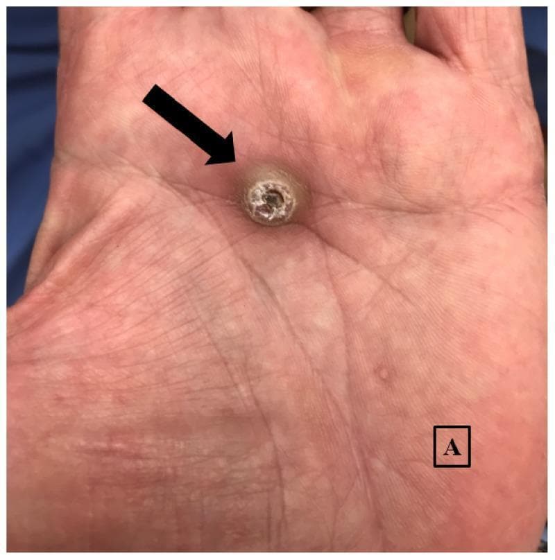 This clinical photograph displays a solitary, well-circumscribed lesion on the central aspect of a human palm. The lesion is a firm, round, dome-shaped nodule measuring approximately 1.5 x 1.2 cm, characterized by a classic crateriform morphology. A prominent central hyperkeratotic keratin plug is visible within the ulceration, which is a hallmark feature of keratoacanthoma, a variant of squamous cell carcinoma. The surrounding palmar skin shows normal dermatoglyphic lines with mild erythema. A black arrow points directly to the primary nodule, and a smaller, less distinct papule is marked with the label 'A' in the distal palmar region for clinical reference. This image serves as a textbook example of a palmar keratoacanthoma, illustrating the importance of recognizing specific morphologic patterns in dermatologic diagnosis.
