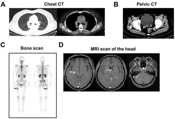 A multi-panel clinical imaging figure demonstrating widespread metastatic disease. (A) Chest CT in axial lung and mediastinal windows showing multiple pulmonary lesions in the inferior lobe of the right lung. (B) Pelvic CT displaying pelvic nodules and involvement of the subcutaneous fat layer. (C) Whole-body bone scan (scintigraphy) in anterior and posterior views showing focal increased radiopharmaceutical uptake (indicated by arrows) in the right femur, consistent with osseous metastasis. (D) Axial head MRI (T1-weighted contrast-enhanced images) revealing multiple intracranial lesions, including enhancing nodules within the brain parenchyma and the right cerebellopontine angle, suggestive of brain and leptomeningeal metastases. Collectively, these images illustrate the systemic spread of metastatic hepatocellular carcinoma (HCC) to the lungs, skeletal system, and central nervous system.