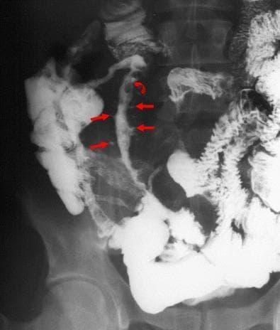 This diagnostic image is a barium follow-through radiograph showing a patient with recurrent active Crohn’s disease in the neo-terminal ileum following prior surgery. The imaging demonstrates severe, irregular luminal narrowing (stricture) of the neo-terminal ileum. Key pathological features include a characteristic 'cobblestoning' mucosal pattern, indicated by a curved red arrow, resulting from interlacing longitudinal and transverse ulcerations. Multiple linear, deep 'rose-thorn' ulcers are highlighted by straight red arrows, appearing as dark indentations within the barium column. The affected ileal segment shows significant separation from adjacent bowel loops, a finding suggestive of transmural inflammation and mesenteric thickening. This case illustrates the classic radiological manifestations of inflammatory bowel disease (IBD) recurrence at the surgical anastomosis, emphasizing the utility of small bowel follow-through for detecting fine mucosal details and structural changes like strictures and deep ulcerations in a clinical setting.