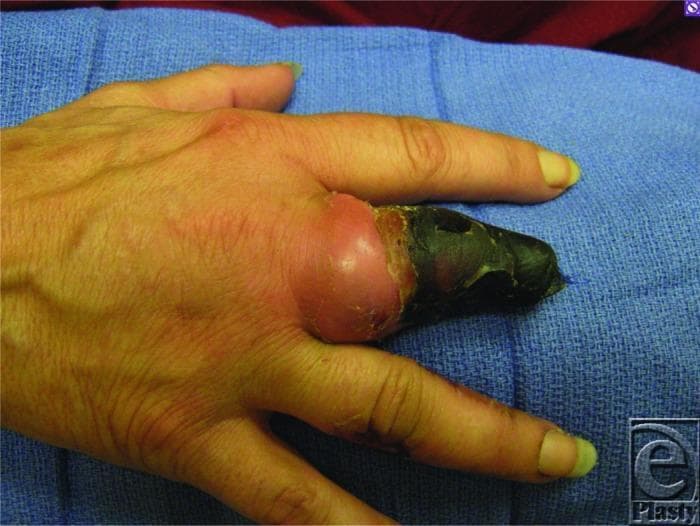 A clinical photograph of a right hand demonstrating advanced digital ischemia and dry gangrene, characteristic of thromboangiitis obliterans (Buerger's disease). The third digit (middle finger) shows a prior partial amputation at the level of the middle phalanx. The residual distal portion of this digit exhibits a dense, black, necrotic eschar consistent with gangrene. There is significant circumferential erythema and swelling proximal to the necrotic tissue, specifically involving the area around the metacarpophalangeal joint, suggesting active inflammation or cellulitis. The surrounding digits show subtle signs of circulatory compromise, including skin pallor and longitudinal nail plate changes. This image serves as an educational example of critical limb-threatening ischemia and the progressive tissue loss associated with small-to-medium vessel vasculitis in tobacco users. The visual findings illustrate the demarcation between necrotic tissue and viable, albeit inflamed, proximal structures.