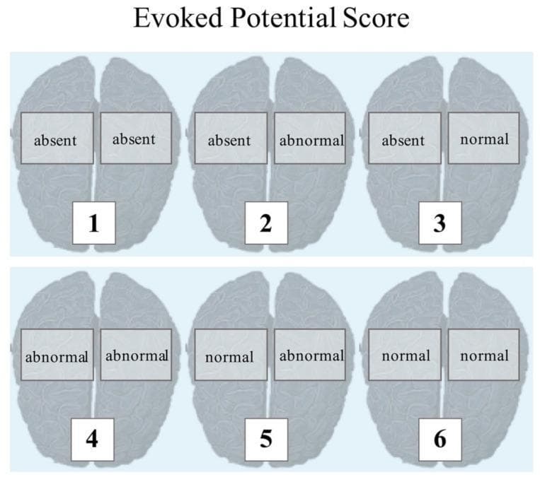This medical infographic illustrates the scoring system for the Evoked Potential Score (EPS), used in assessing Somatosensory Evoked Potentials (SSEP) and Brainstem Auditory Evoked Potentials (BAEP) in neurological patients. The layout features six anatomical diagrams of the human brain from a superior (top-down) view, arranged in a 2x3 grid. Each brain is divided into left and right hemispheres, each labeled with a qualitative assessment: 'absent', 'abnormal', or 'normal'. Each diagram corresponds to a numerical EPS value from 1 to 6. The sequence demonstrates a hierarchical progression of electrophysiological recovery or function: (1) Bilateral absent, (2) Left absent/Right abnormal, (3) Left absent/Right normal, (4) Bilateral abnormal, (5) Left normal/Right abnormal, and (6) Bilateral normal. This grading system provides a standardized method for clinicians to quantify neurophysiological status, specifically in contexts like poor-grade subarachnoid hemorrhage (SAH) or ventilator weaning, where prognostic markers for neurological improvement and the modified Rankin Scale (mRS) are evaluated.