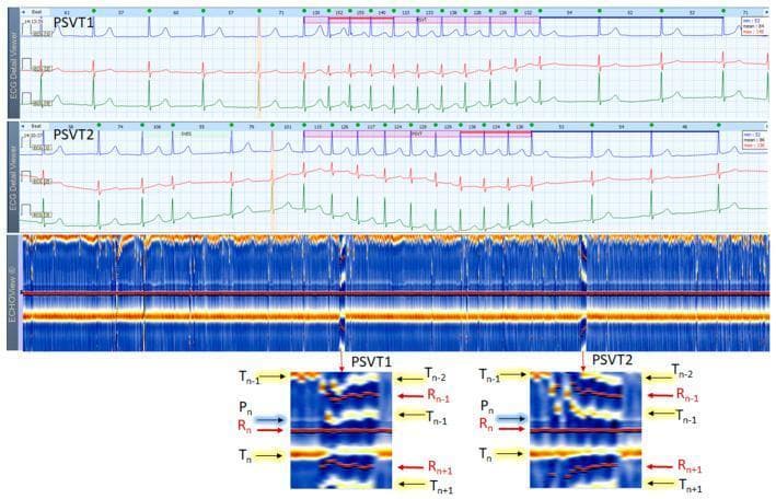 This composite medical image displays two 3-lead Holter ECG strips and a corresponding ECHOView color map from a 37-year-old female patient, illustrating paroxysmal supraventricular tachycardia (PSVT). The top panels show traditional ECG traces highlighting two PSVT episodes (PSVT1 and PSVT2) boxed in pink, characterized by rapid, narrow QRS complexes and heart rates between 115-155 bpm. The middle panel presents the ECHOView color map, which transforms ECG amplitudes into a color-coded visualization. A central horizontal red line represents the R-peaks (ventricular depolarization) used for beat alignment. Orange-white horizontal bands indicate T-waves (ventricular repolarization), while blue-white traces represent P-waves (atrial depolarization). The bottom zoomed sections specifically detail the PSVT episodes, showing the interruption of the normal P-wave band and the embedding of the P-wave (Pn) into the preceding T-wave (Tn-1). This visual evidence aids in differentiating between supraventricular tachycardia subtypes, such as atrioventricular reentrant tachycardia (AVRT) versus atrioventricular nodal reentrant tachycardia (AVNRT).