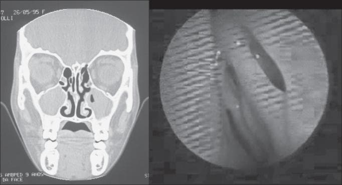 This composite clinical image presents a side-by-side comparison of diagnostic modalities for chronic rhinosinusitis (CRS). On the left, a coronal CT scan of the paranasal sinuses shows significant soft tissue opacification in the bilateral maxillary and ethmoid sinuses, indicating a positive diagnosis for sinusitis according to Lund-Mackay staging criteria. The nasal septum is centered, and inferior turbinates are visible. On the right, a corresponding nasofibroscopy (endoscopy) frame provides a direct view of the nasal passage and mucosa. In this specific case, the endoscopic view appears negative for classic signs of CRS, demonstrating smooth mucosa without evident purulent secretion, polyps, or significant edema in the visible meatus. The pairing illustrates a clinical 'disagreement' where radiologic evidence suggests disease that is not immediately visible via endoscopy, highlighting the diagnostic complexity of sinonasal pathology in otolaryngology.