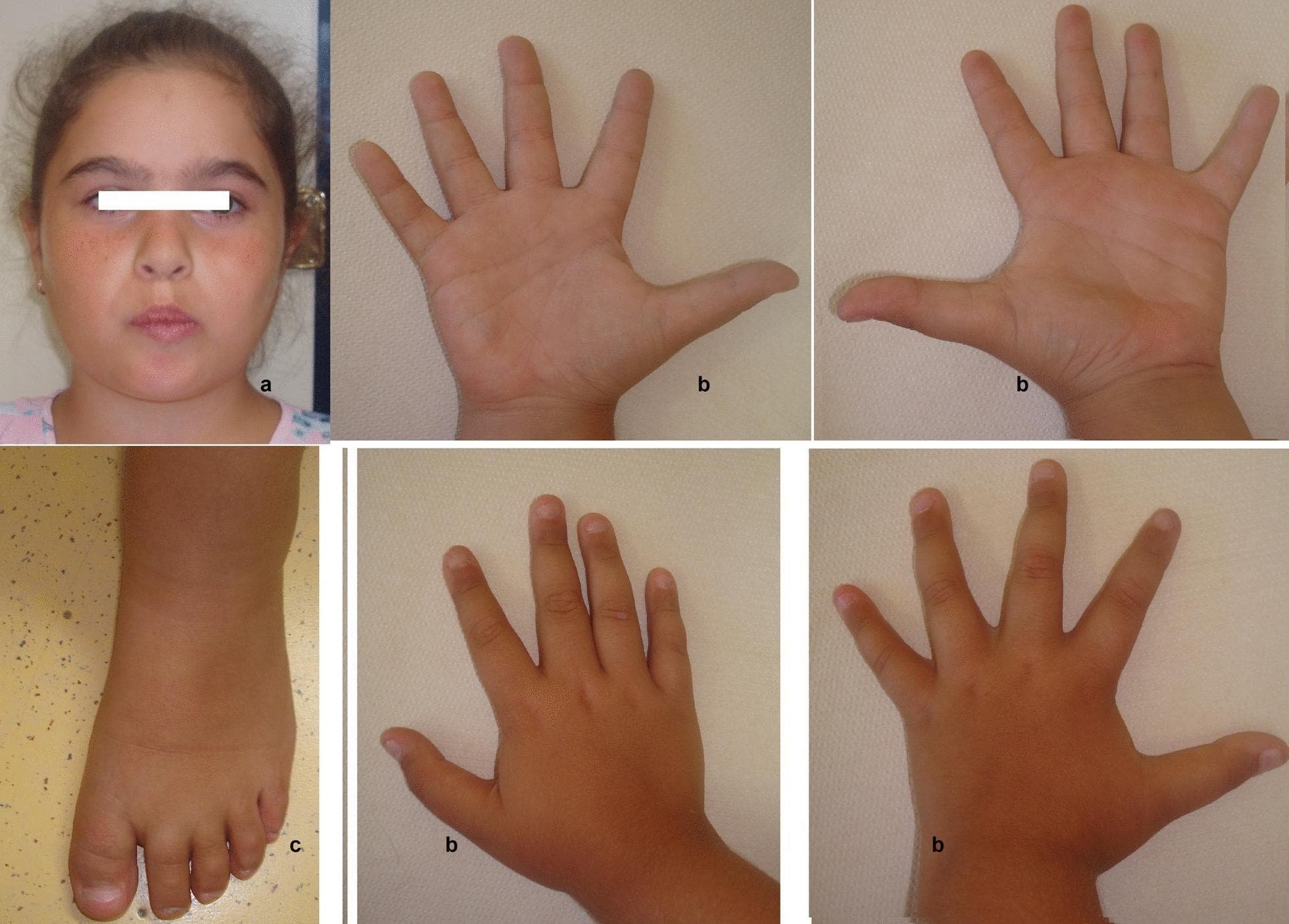 This composite of clinical photographs illustrates the external phenotypic features of a 9-year-old female patient with a partial trisomy 21 (PT21). Panel (a) shows a frontal view of the face; notable observations include a lack of characteristic Down syndrome (DS) craniofacial features, such as upslanting palpebral fissures, epicanthal folds, or a flattened nasal bridge. Panels (b) provide multiple views of the hands (palmar and dorsal surfaces), showing five digits on each hand with normal proportions, typical skin creases, and no evidence of clinodactyly or a transverse palmar crease (simian crease). Panel (c) displays the dorsal view of the left foot, demonstrating five toes with normal morphology and healthy nail plates. The primary educational focus of this visual is to demonstrate that certain chromosomal duplications involving chromosome 21 (specifically those excluding the Highly Relevant Down Syndrome Critical Region or HR-DSCR) may present without the classical 'Down syndrome' recognizable phenotype, despite genetic partial trisomy.