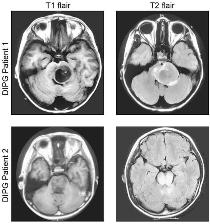 This diagnostic imaging panel presents axial brain MRI scans from two pediatric patients demonstrating radiographically classic Diffuse Intrinsic Pontine Glioma (DIPG). The panel is organized into a 2x2 grid comparing T1-weighted (left) and T2-weighted (right) sequences for Patient 1 and Patient 2. In both cases, the MRI reveals a hallmark space-occupying lesion centrally located within the pons. Patient 1 displays a well-defined pontine mass that is predominantly hypointense to isointense on T1 with a dark central core, appearing hyperintense on T2. Patient 2 exhibits a more ill-defined, expansive lesion that significantly enlarges the pons, showing similar T1 hypointensity and T2 hyperintensity. The images demonstrate the characteristic 'expansile' nature of DIPG, which typically involves more than 50% of the pons and often engulfs the basilar artery. These scans illustrate the essential role of MRI in diagnosing high-grade brainstem gliomas in children based on anatomical location and signal intensity characteristics relative to normal brain tissue.