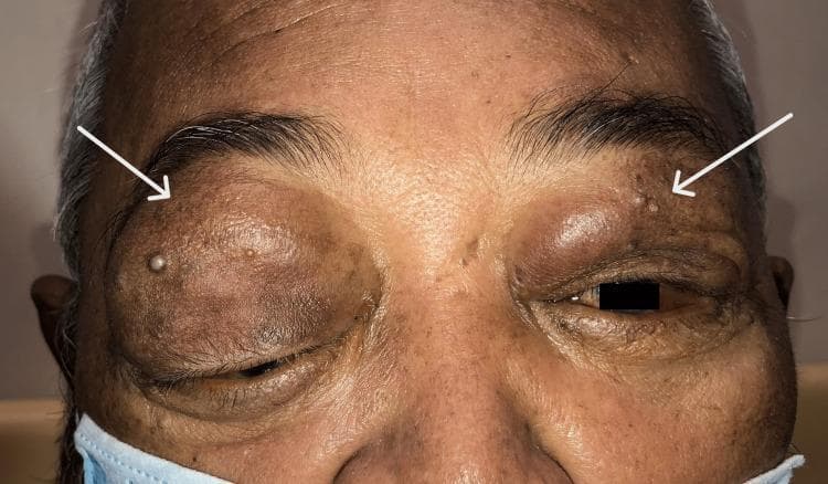 A clinical photograph showing the periorbital region of a patient with bilateral upper eyelid swelling and mechanical ptosis. The swelling is asymmetrical, being significantly more pronounced on the right side, where the mass effect has caused inferior dystopia (downward displacement) of the globe. The skin of the upper eyelids is hyperpigmented and appears firm and lobulated, consistent with underlying orbital masses. White arrows point to small, discrete, flesh-colored papular skin lesions located on the upper eyelids and supraorbital brow area. The clinical presentation is indicative of bilateral orbital involvement, which in this context represents diffuse large B-cell lymphoma (DLBCL) affecting the lacrimal glands. The image illustrates the external ocular manifestations of orbital lymphoma, including proptosis, lid edema, and mechanical secondary effects on eye position and eyelid function.