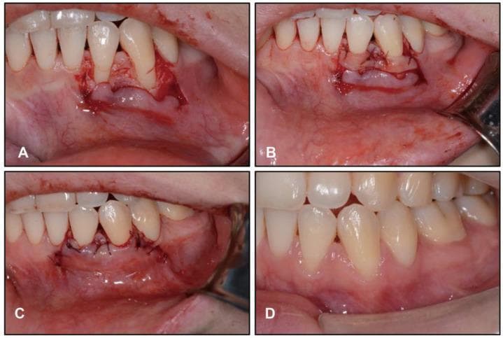 This composite of four clinical intraoral photographs documents a mucogingival surgery for root coverage of the mandibular left lateral incisor and canine. Image A illustrates the initial surgical phase with a full-thickness flap detachment extending beyond the mucogingival junction, exposing the underlying alveolar bone and root surfaces. Image B displays the placement of a subepithelial connective tissue graft, which is secured to the recipient site using fine resorbable sutures to ensure graft stability and close adaptation to the root surfaces. Image C shows the coronally advanced flap positioned over the graft and fixed with sling sutures at the interdental papillae, which provides tension-free closure and coronal positioning. Image D captures the post-operative outcome two months later, demonstrating successful healing, significantly increased zones of keratinized tissue, and successful root coverage with healthy gingival contours and integration of the grafted tissue.