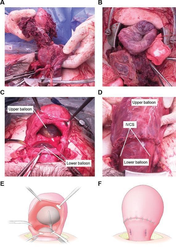 A composite image containing clinical photographs and schematic diagrams (A-F) documenting the management of postpartum hemorrhage (PPH) caused by uterine inversion and severe uterine atony. Panels A and B show the surgical field during cesarean section with an inverted, dark red, congested uterus and adherent placental tissue. Panels C and E (photograph and diagram) demonstrate the intraoperative placement of a double-balloon tamponade (UBT) system through a uterine incision, with an 'upper balloon' positioned in the uterine corpus and a 'lower balloon' in the isthmus. Panels D and F (photograph and diagram) illustrate the postoperative state where Isthmus Vertical Compression Sutures (IVCS) have been applied. These white, vertical sutures compress the lower uterine segment between the two inflated balloons to achieve hemostasis. The sequence highlights a step-by-step minimally invasive technique combining mechanical pressure and surgical compression to treat life-threatening obstetric hemorrhage.